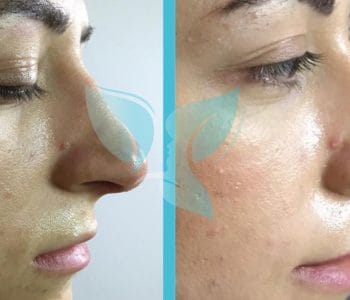 لقاح-السلمون