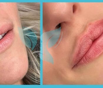 إجراءات النفخ غير الجراحية